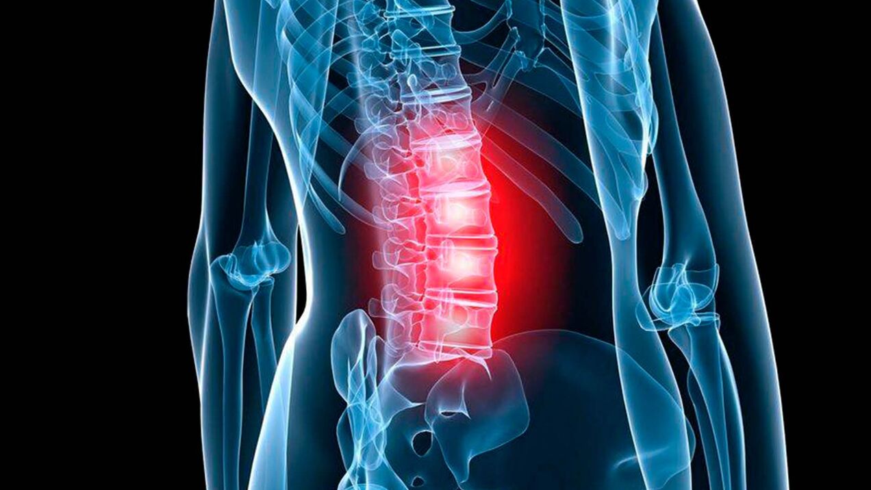 sintomi di osteocondrosi lombare
