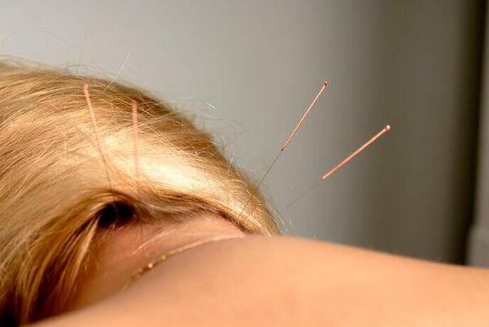Agopuntura per l'osteocondrosi