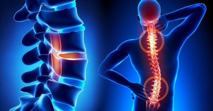 localizzazione del dolore nell'osteocondrosi